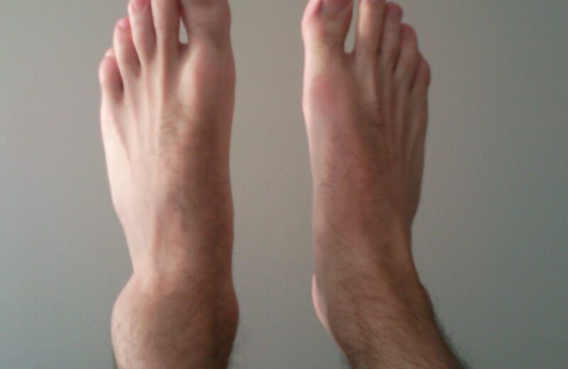 Ankle Sprain Recovery: Why Most People Heal Wrong and How to Do It Right