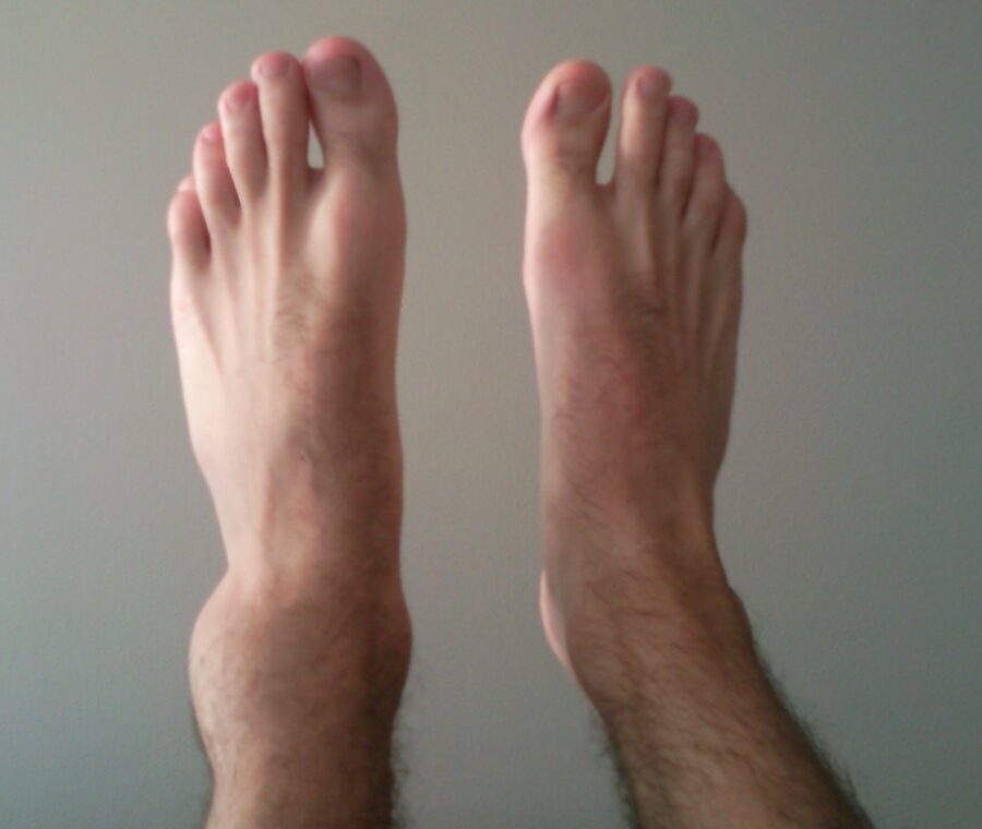 Ankle Sprain Recovery: Why Most People Heal Wrong and How to Do It Right